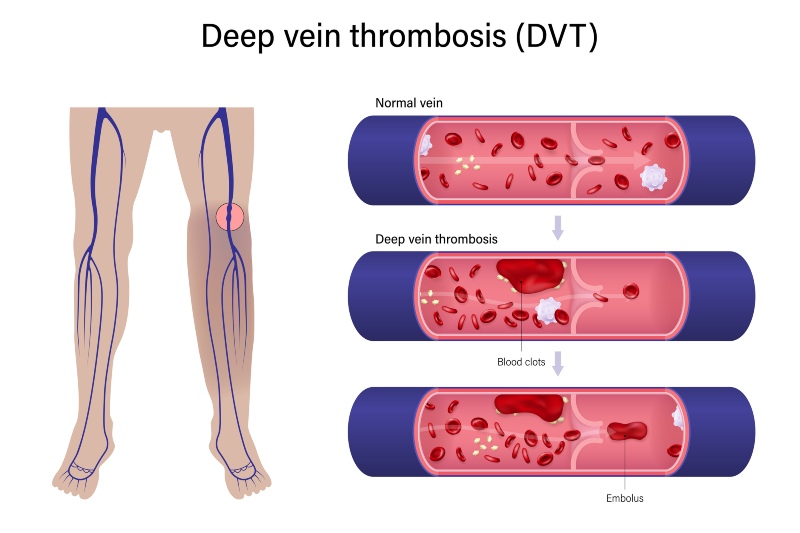 Signs and Symptoms of Deep Vein Thrombosis by Revamp Heart & Vascular Institute