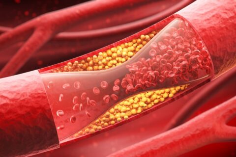 Signs and Symptoms of Peripheral Artery Disease by Revamp Heart & Vascular Institute