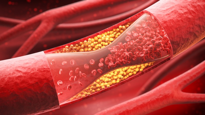 Signs and Symptoms of Peripheral Artery Disease by Revamp Heart & Vascular Institute