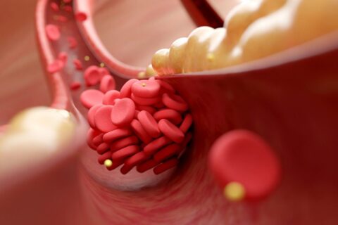 Early Symptoms of Poor Blood Flow By ReVaMP Heart & Vascular Institute