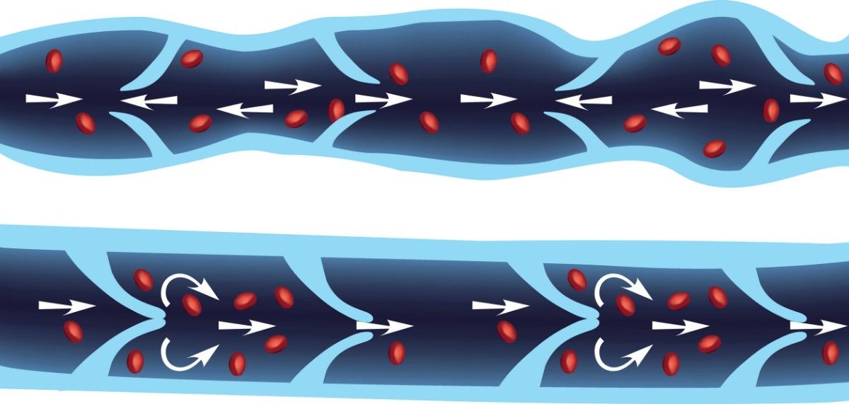 Step-By-Step Varicocele Embolisation Process at ReVaMP Heart & Vascular Institute