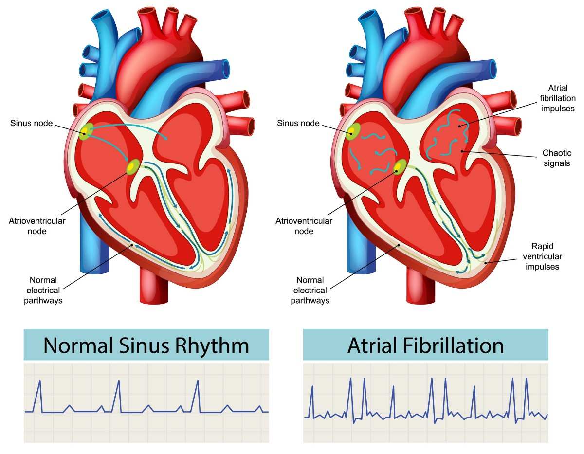 Benefits of Varicocele Embolisation Explained By ReVaMP Heart & Vascular Institute
