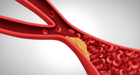 Triglyceride-Rich Lipoproteins and Vascular Risk By ReVaMP Heart & Vascular Institute