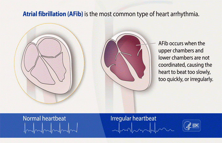 Atrial Fibrillation Diagnosis