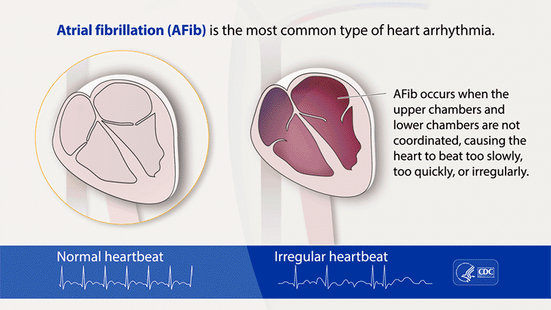 What is AFib animation (Credit: CDC)
